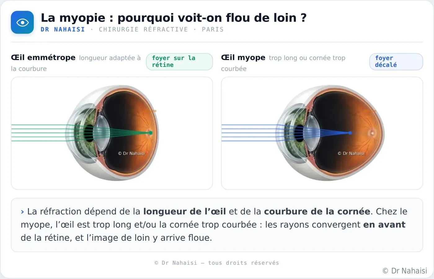 Comment le laser corrige la vue