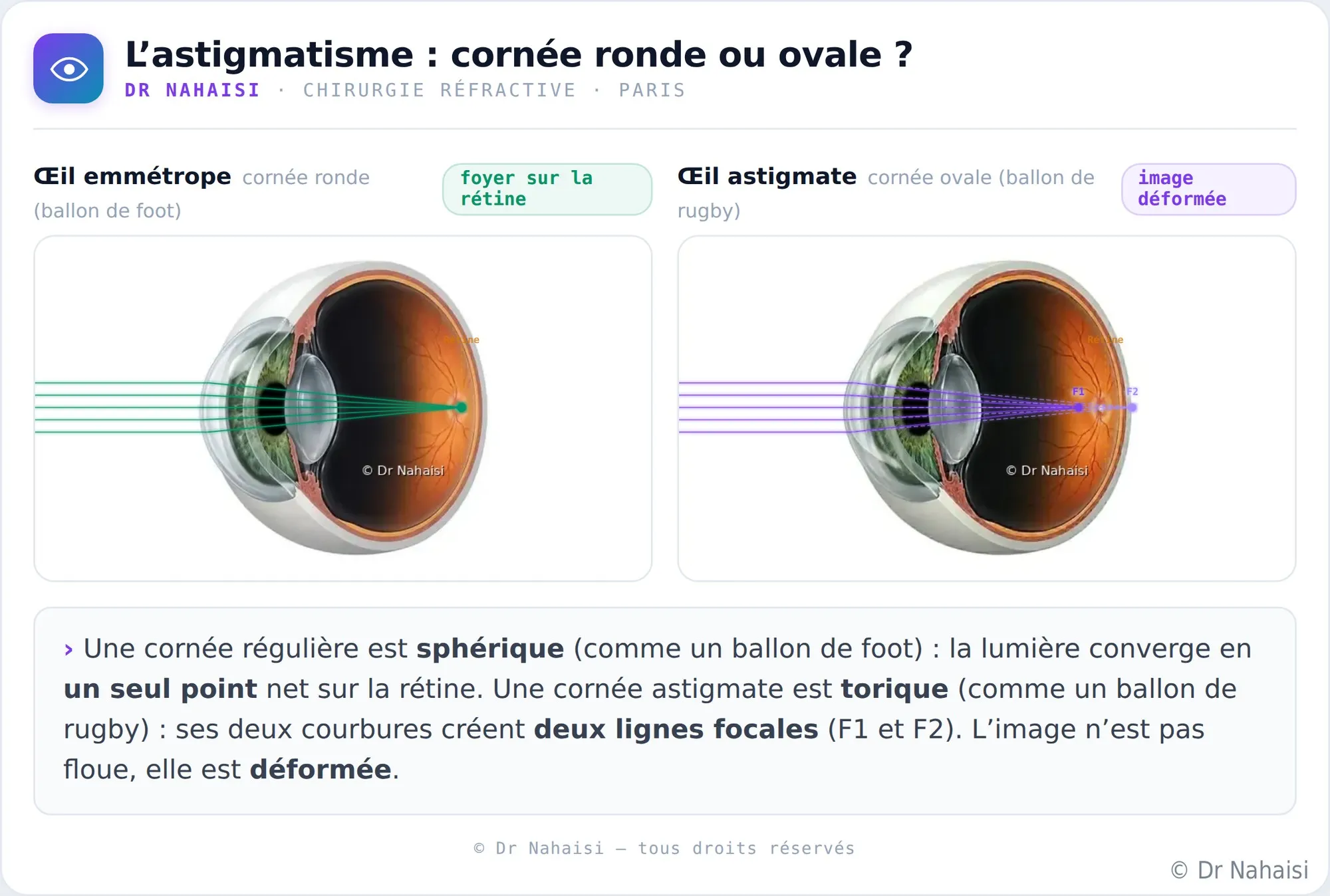 Opération de l’astigmatisme au laser à Paris