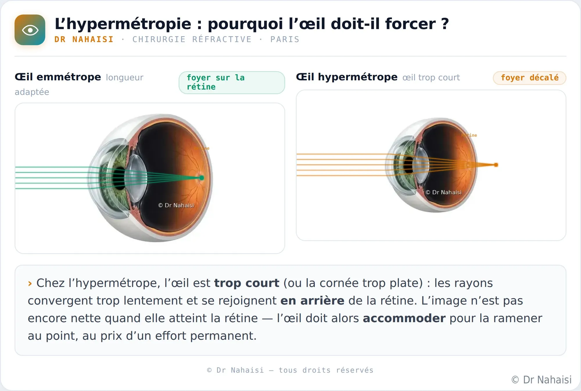 Opération de l’hypermétropie au laser à Paris