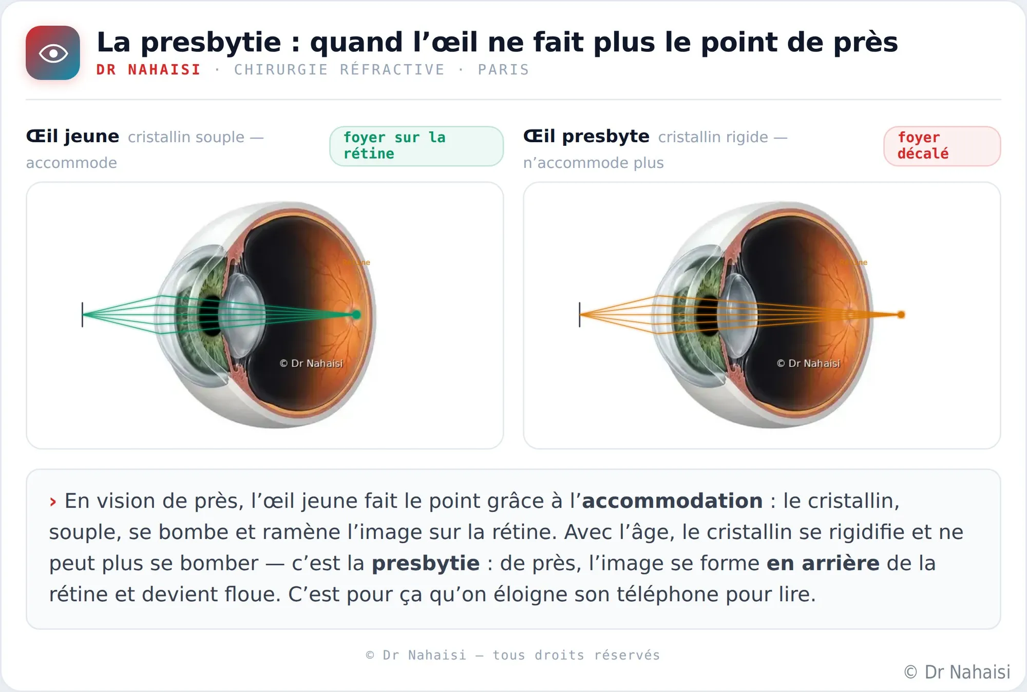 Le PresbyLASIK, corriger la presbytie au laser