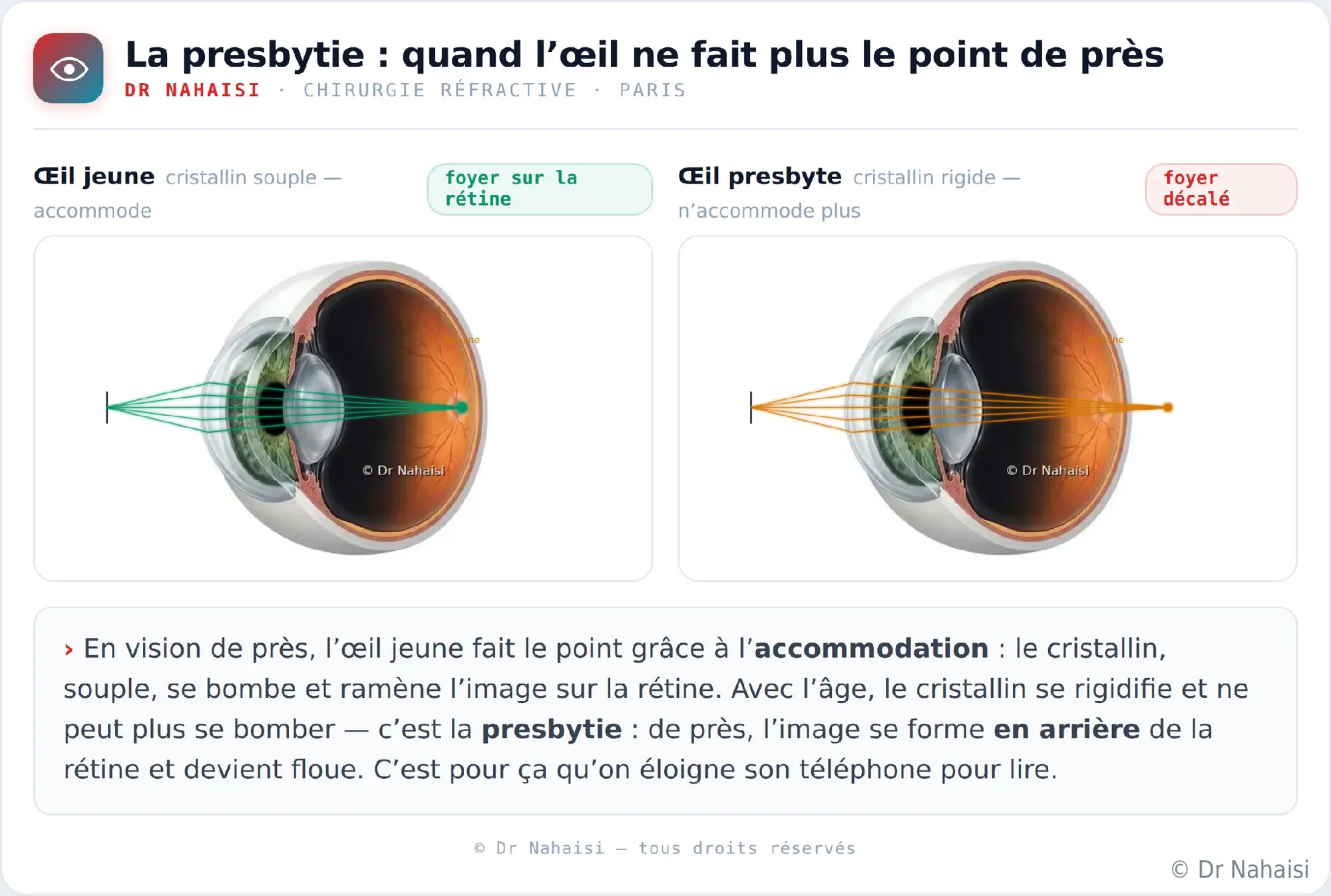 Corriger la presbytie au laser à Paris