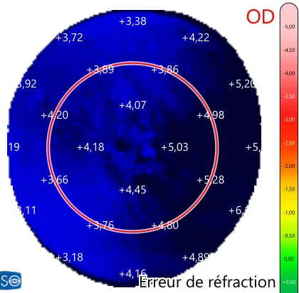 Aberrometry map of the right eye: hyperopic correction ranging from about +3.4 to +5.3 diopters across the pupil