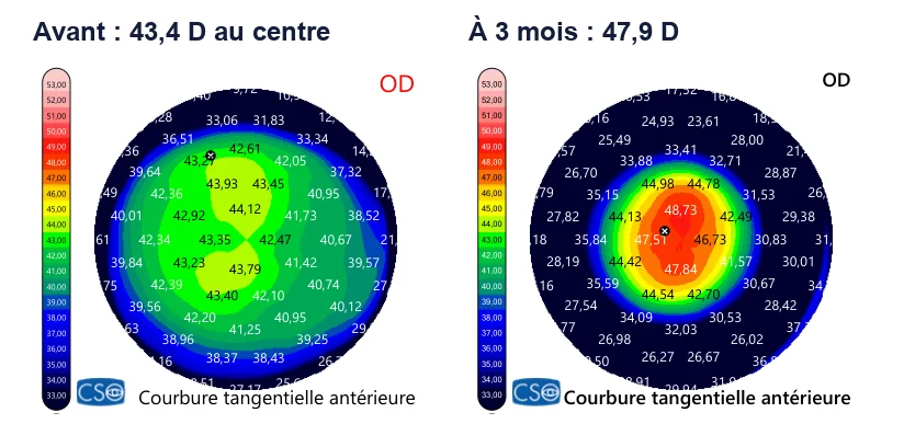 Cartes de courbure de la cornée droite : centre vert à 43 dioptries avant l'opération, centre rouge à 48 dioptries trois mois après