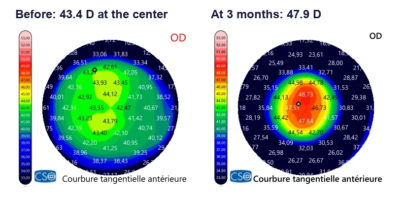 Curvature maps of the right cornea: green center at 43 diopters before surgery, red center at 48 diopters three months later