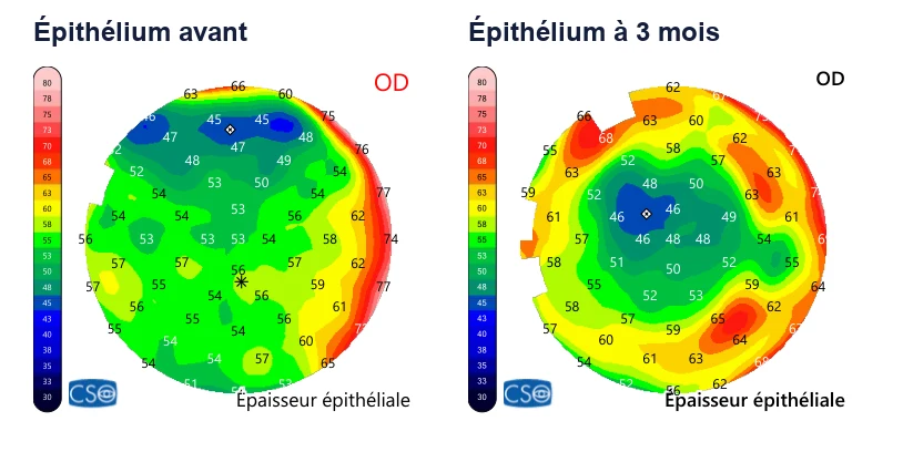 Cartes d'épaisseur de l'épithélium : uniforme autour de 54 microns avant, plus fin au centre et plus épais en anneau trois mois après