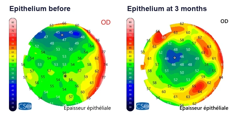 Epithelial thickness maps: uniform at around 54 microns before, thinner in the center and thicker in a ring three months later