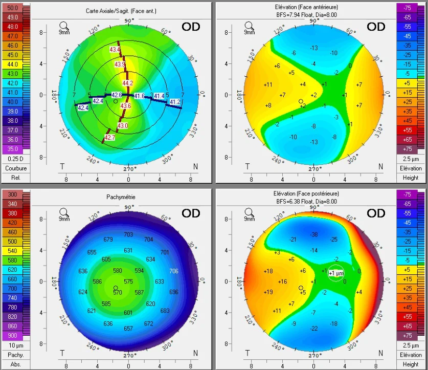 Pentacam of the right eye before surgery: regular curvature around 43 diopters, normal anterior and posterior elevation, thickness of 570 microns at the center