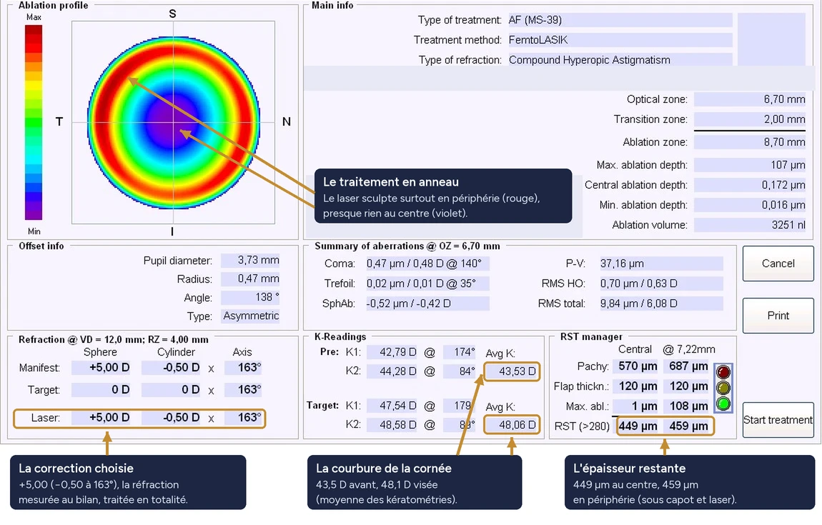 Plan de traitement Schwind de l'œil droit : profil d'ablation en anneau rouge autour d'un centre violet presque intact, zone optique 6,70 mm, ablation maximale 107 microns